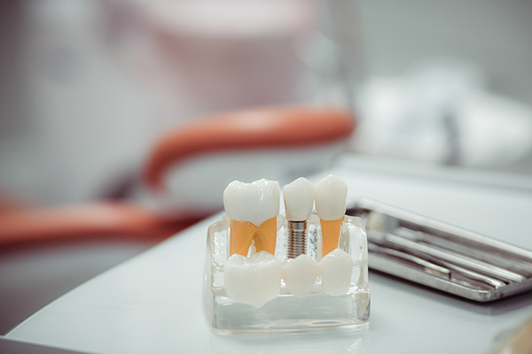 Dental Implants Are A Solution For Missing Teeth